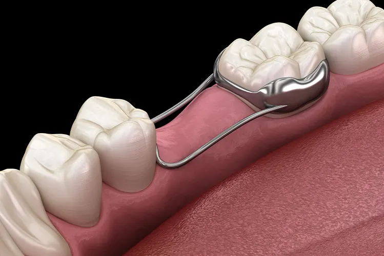 Dental Space Maintainers Marshfield Pediatric Dentistry